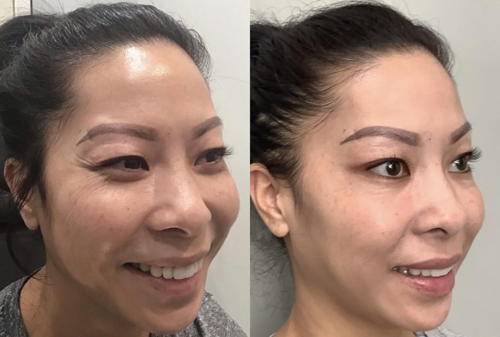 Jelly Roll Botox: Giải pháp cho sự lão hóa và phương pháp giảm thâm vùng mắt