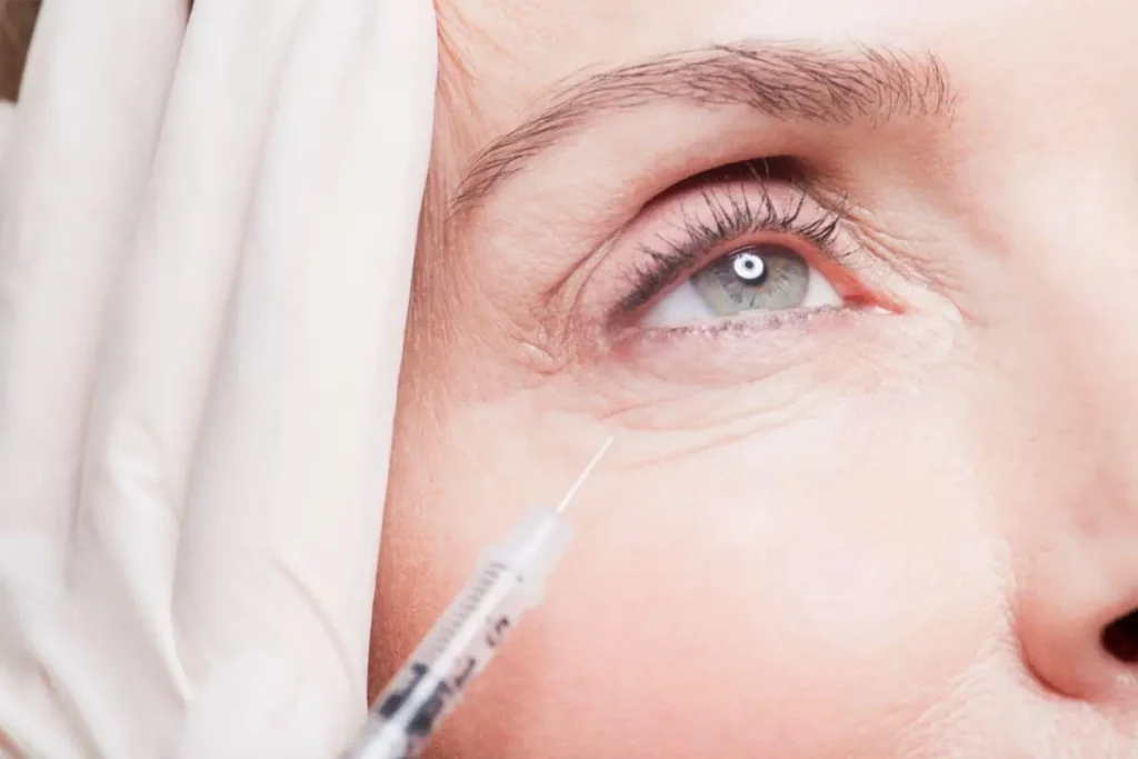 Jelly Roll Botox: Giải pháp cho sự lão hóa và phương pháp giảm thâm vùng mắt